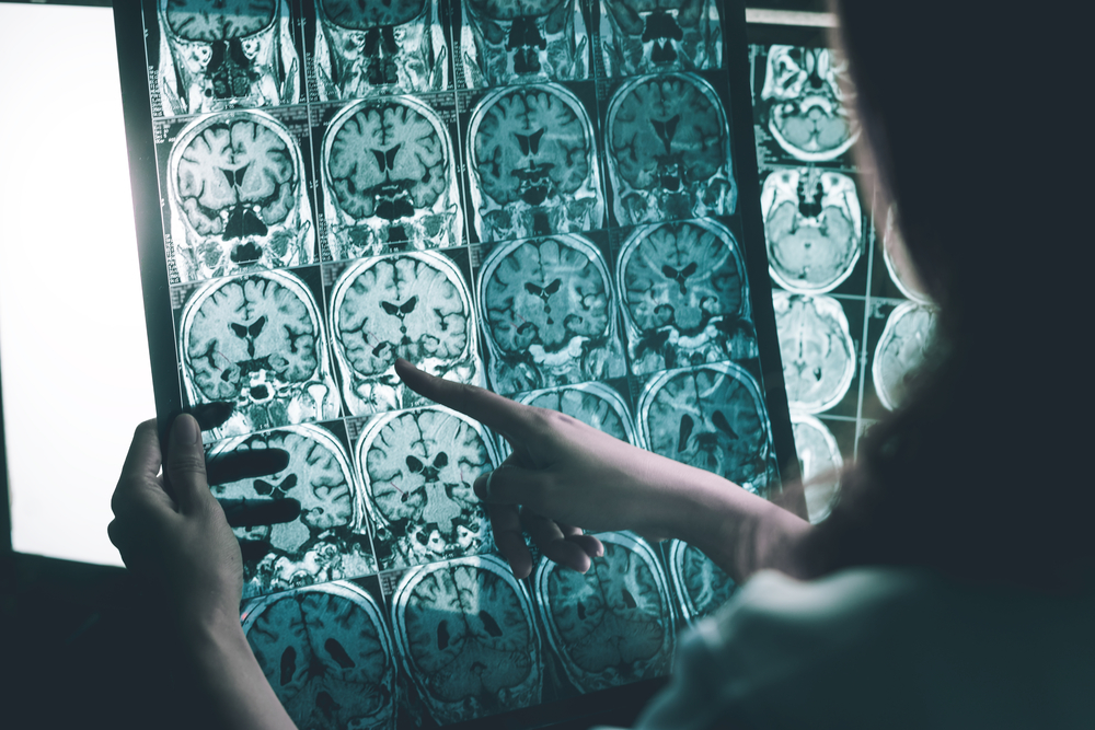 Diagnóza alzheimerovy choroby se potvrzuje magnetickou rezonancí