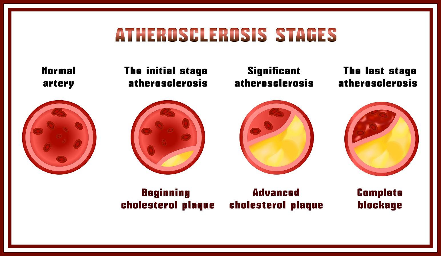 Stádia aterosklerózy
