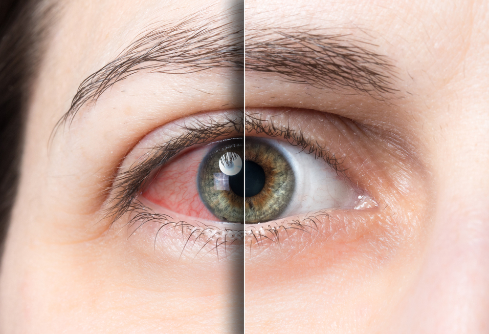 Červené oči, pálení nebo naopak suchost mohou být velkým problémem, který byste neměli podceňovat.